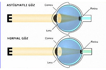 Astigmatizm Nedir