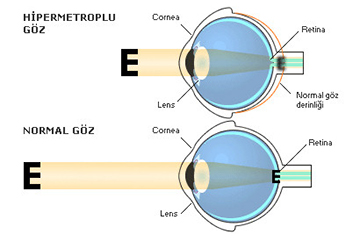 Hipermetrop Nedir